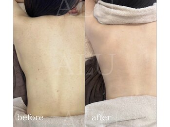 アルフォービューティー 恵比寿店(ALU for beauty)/背中症例