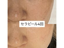 ヴィヴ 三島店(Vive)/《セラピール》症例