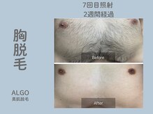 アルゴ 山口宇部店(ALGO)/脱毛初めて！7回目でこの効果！