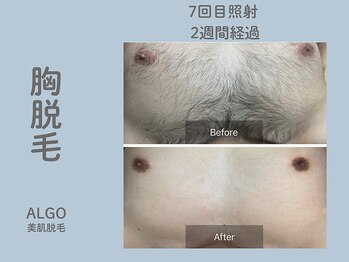 アルゴ 山口宇部店(ALGO)/脱毛初めて!7回目でこの効果!