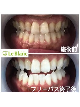 ルブラン 奈良店(Le Blanc)/抜群の効果！！