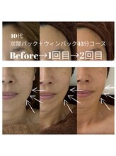 エステサロン クレイドルフェザー/最先端技術の炭酸パックでケア