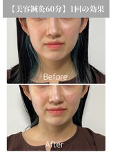 サンクエール 代官山鍼灸院(CINQ AILES)/美容鍼灸　小顔/リフトアップ