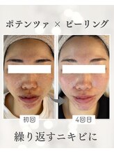 リノ ショウナン(LINO SHONAN)/ポテンツァ×ピーリング