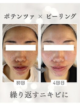 リノ ショウナン(LINO SHONAN)/ポテンツァ×ピーリング