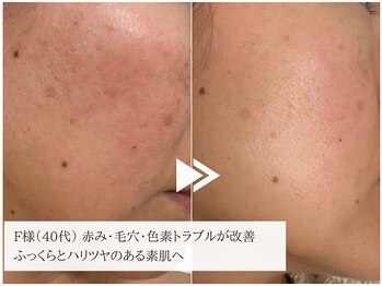 レイテノール 藤沢店の写真/【本気のシミ改善×エイジングケア】全国受賞歴多数◎高機能化粧品で内側から輝く透明美肌を実感♪