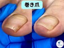 巻き爪矯正は専門店へ●