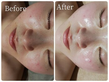 サロン ド ヒノキ(Salon de HINOKI)/肌質改善ハーブピーリング