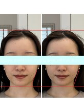 キレミラ 麻布十番店/リフトアップBefore/After(1)