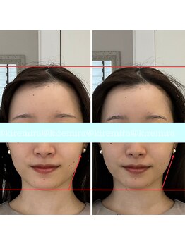 キレミラ 麻布十番店/リフトアップBefore/After(1)