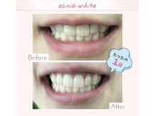 エクシアホワイトニング 調布店/30代女性会員様/1回目