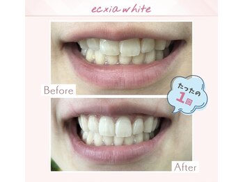 エクシアホワイトニング 調布店/30代女性会員様/1回目