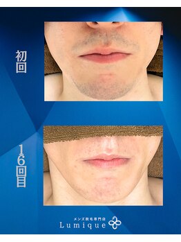 ルミーク(Lumique)/Before After I様