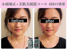 キュープ 表参道店(Qpu)/美顔器モニターコース4回の変化
