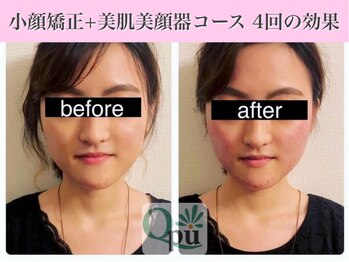 キュープ 表参道店(Qpu)/美顔器モニターコース4回の変化
