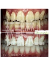 ホワイトニングサロン 広島店/【ホワイトニング施術例】