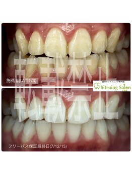 ホワイトニングサロン 広島店/【ホワイトニング施術例】