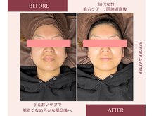 ウェルネス ステーション リンク(Wellness Station Link)/毛穴ケア　ビフォーアフター