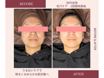 ウェルネス ステーション リンク(Wellness Station Link)/毛穴ケア ビフォーアフター