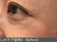 オアシスラグーン(OASIS LAGOON)/しわ改善（症例3 before）50代