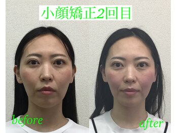 オズ六本木/小顔矯正モニター2回目
