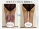 アピ(api)の写真/大人気★【術後インディバ120分￥22,000→￥14,000】二の腕/太もも/お腹/背中/全身の吸引/術後ケア対応★