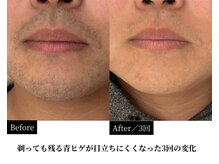 ダイヤ 名古屋中川区店(Daiya)/【青ヒゲの変化実例】3回経過