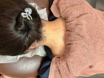 ピース鍼灸整骨院の写真/心地よく痛みが少ない鍼で身体の不調にアプローチ! 慢性的な首肩こりや腰のつらさでお悩みの方にオススメ♪