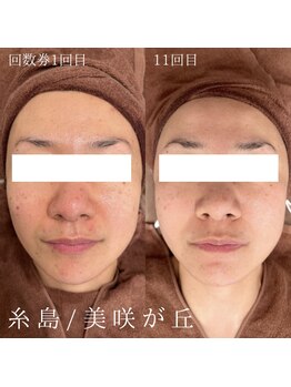 てづか整骨院 美咲が丘院/【サロン】フェイシャル回数券