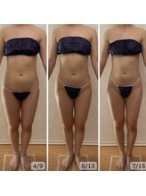 プリマ(prima)/ダイエット症例