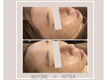 ミルトゥ(myrte)/Before→After ニキビケア