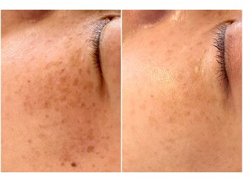 ジン フォー ユアビューティー(JIN for your beauty)/施術経過