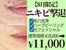 【8月限定ニキビ徹底ケア】毛穴洗浄+ピーリング+光フェイシャル¥18000→