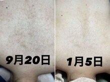 ファルファラ(farfara)/天然ハーブピーリング