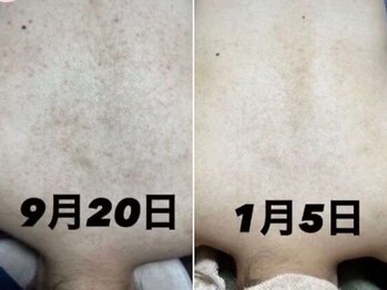 ファルファラ(farfara)/天然ハーブピーリング