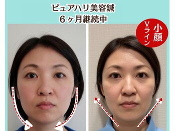 ピュアハリ/沖縄美容鍼 効果