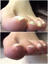 モアクリスタル(More Crystal)/巻き爪補正