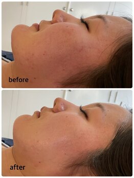 マーキュリー(Mercury)/美容鍼灸+ハーブのお客様