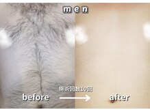 キュー(cue)/【メンズ】「胸脱毛」施術事例