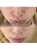 《肌質根本改善セット》毛穴洗浄×ハーブピーリング ¥22000→¥12800