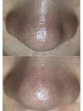 エヌ ドット ジュウイチ(N.11)/黒ずみ毛穴洗浄