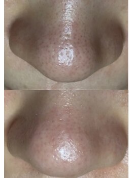 エヌ ドット ジュウイチ(N.11)/黒ずみ毛穴洗浄