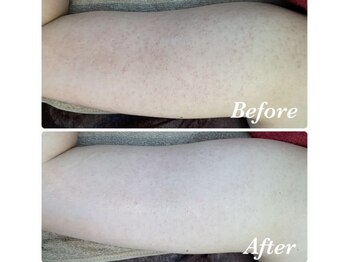 ルアナアイナ(Luana Aina)/二の腕ケア/ハーブピーリング