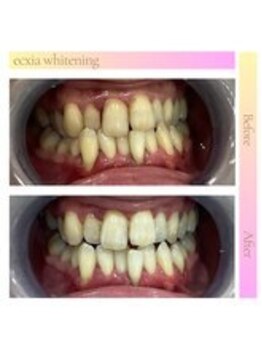 エクシアホワイトニング 西宮北口店/ホワイトニングビフォーアフター