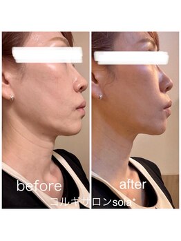 ソラ(sola*)/脂肪分解『レモンボトル』