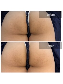 ビビ(VIVI)/お尻のザラつき、黒ずみに！