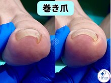 プラスワンフット 本厚木(+1 Foot)/巻き爪矯正は専門店へ●