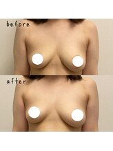 セイ(SEI)/B→A 下垂、ハリ