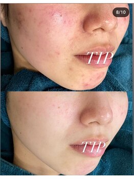 ビーピー 渋谷(b.p.)/毛穴、ニキビケア