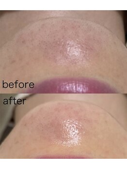 毛穴塾/無添加フェイシャルWAX脱毛